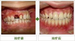 老年人镶牙补牙需要注意什么