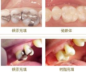 牙齿蛀空了要拔牙吗