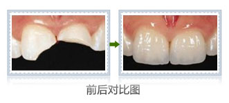 纳米树脂补牙多少钱