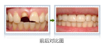 牙齿补牙材料能维持多久