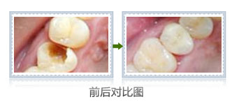 蛀牙要及时补吗