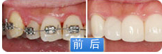 陶瓷自锁托槽牙套多少钱