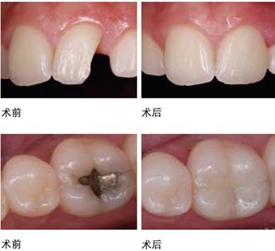 补蛀牙痛不痛